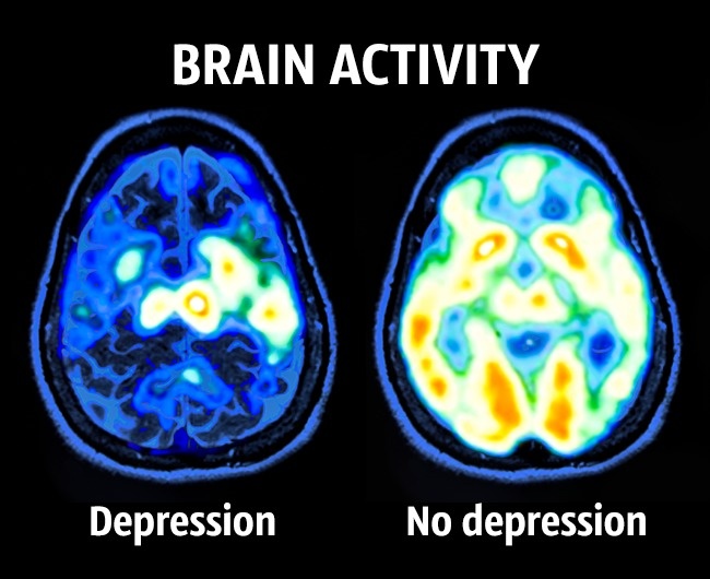depression in the brain