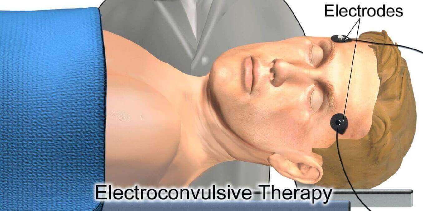 Electroconvulsive Therapy For Paranoid Schizophrenia And Depression ...