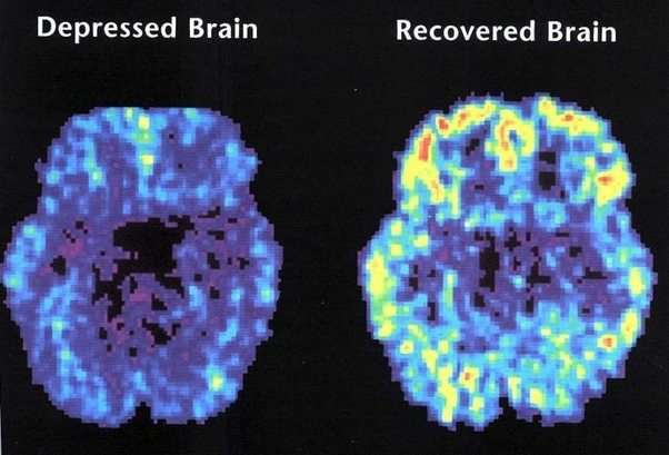 What parts of the brain does depression affect?